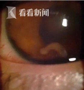 ​成都老传统-刀峰洗眼，刀片伸进眼睛刮眼球，清洗眼睛，濒临失传