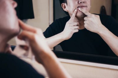 ​长痤疮怎么治疗 长“痤疮”毁颜值？这样吃就对了