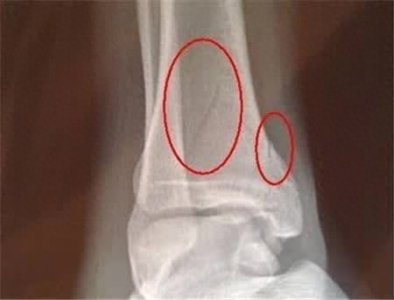 ​骨折后长骨痂是什么感觉?X线一直有骨折线代表着什么？