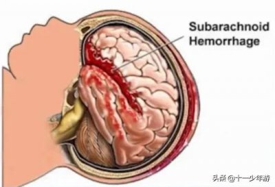 ​蛛网膜下腔出血