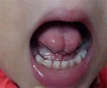 ​舌系带 舌系带过短要不要剪？