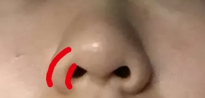​鼻翼怎么缩小 鼻翼肥大的鼻子应该如何改善？