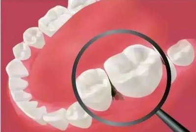 ​牙缝臭怎么办快速解决（吃东西老塞牙，牙缝里有臭味！怎么办？）