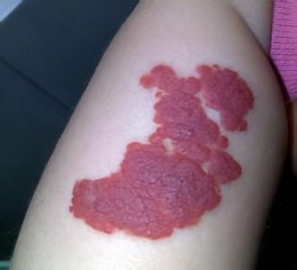 ​出现这种红色丘疹千万别大意，可能是血管瘤！