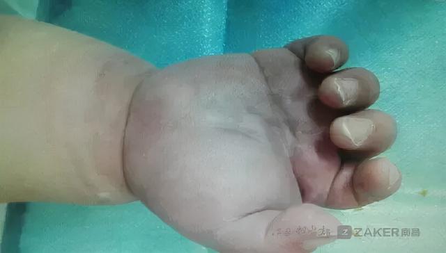 压脉带怎样压迫动脉(一根压脉带差点毁了一只手)(1)