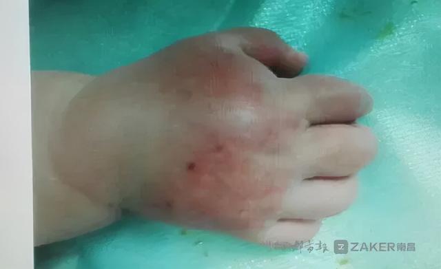 压脉带怎样压迫动脉(一根压脉带差点毁了一只手)(2)