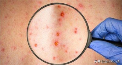 身上有红色的小血点不痒不疼痛 身上出现很多小红点,不痛不痒是怎么回事?听听