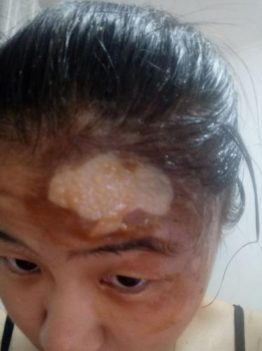 开水烫了怎么办(手被开水烫了怎么办)-第1张图片-